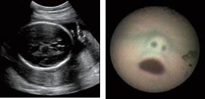 胎児の超音波画像（左）と内視鏡画像からの胎児の口の検出（右）
